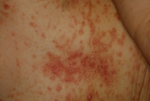 Psoriazis