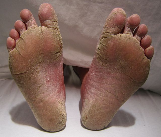 micoza degetelor de la picioare)