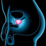Cancerul de prostata – analize gratuite pentru depistarea bolii (VIDEO)